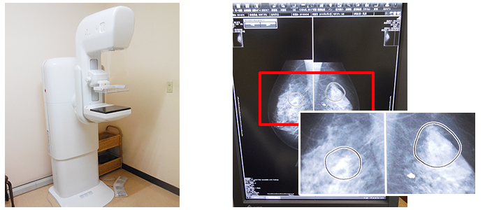 マンモグラフィー